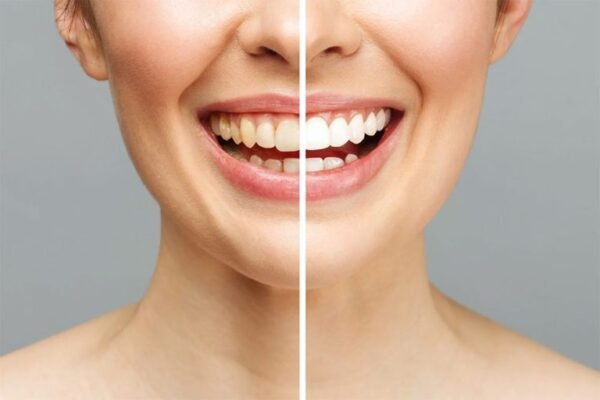 How Much Does Teeth Whitening Cost in Taunton