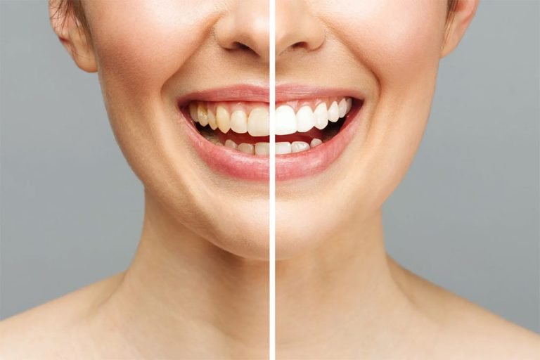 How Much Does Teeth Whitening Cost in Taunton
